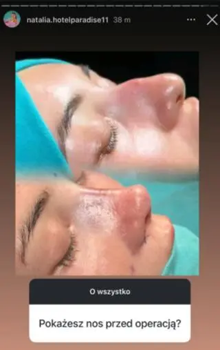 Natalia z "Hotelu Paradise 11" pokazała, jak wyglądała przed operacją nosa
