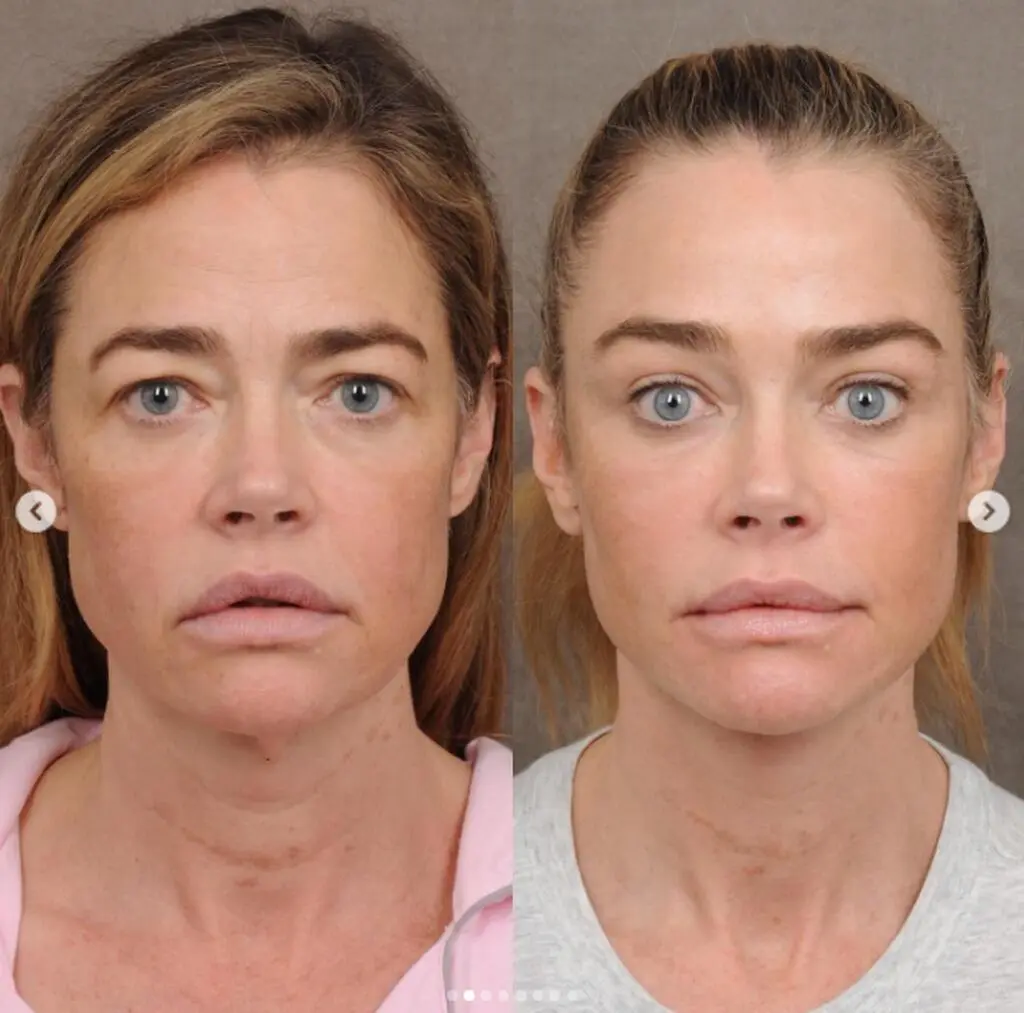 Denise Richards po liftingu