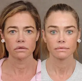 Denise Richards po liftingu