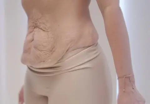 Bohaterka "Anatomii piękna" o bolesnym kompleksie. "Nie mam brzucha, mam worek"