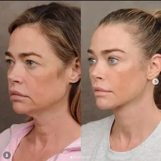 Denise Richards po liftingu