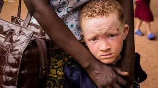 Albinosi w Tanzanii