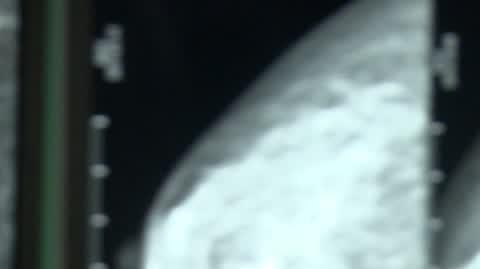 mammografia ai
